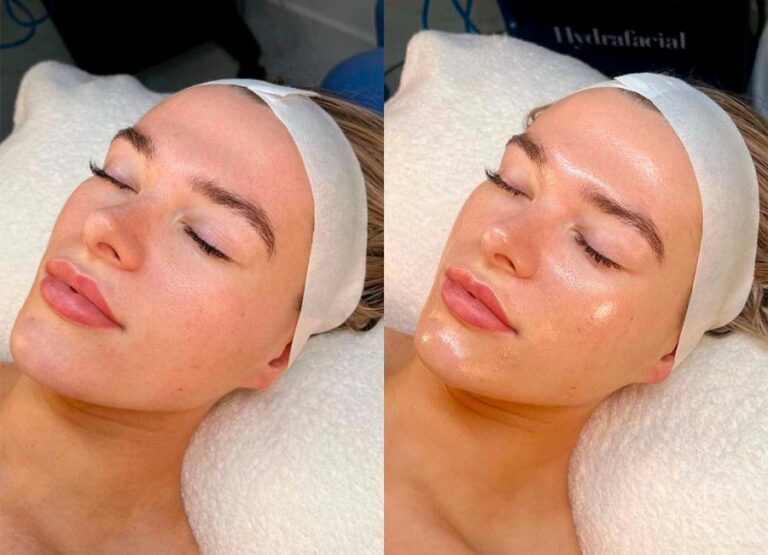 Hydrafacial Platinum - Facial clinique 00008